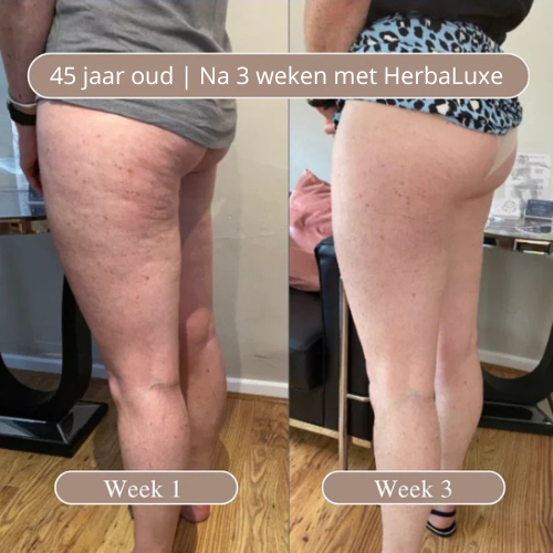 HerbaLuxe Anti-Cellulite Massage Oil